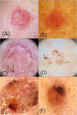 Frontiers Role Of Dermoscopy In The Assessment Of Basal Cell Carcinoma